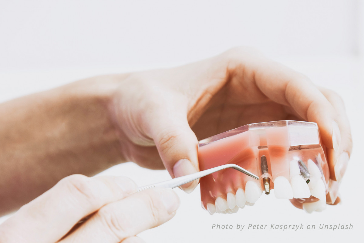 Koje su posljedice gubitka zubi i zašto je važno nadomjestiti izgubljene zube?